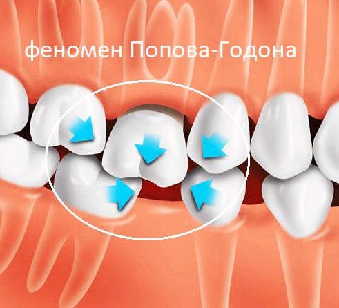 Зуб-антагонист (это такой же зуб, только на другой челюсти), выпячиваясь из десны, создает блок, мешающий нормальному функционированию челюстей